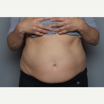 55-64 year old woman treated with SculpSure before 3584217