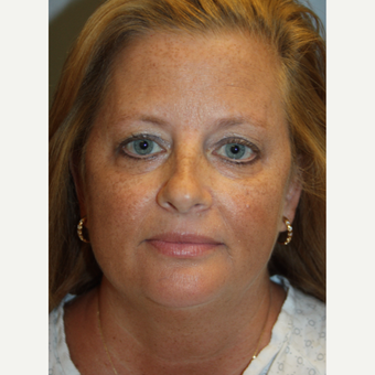 35-44 year old woman treated with Fraxel Repair before 3708645