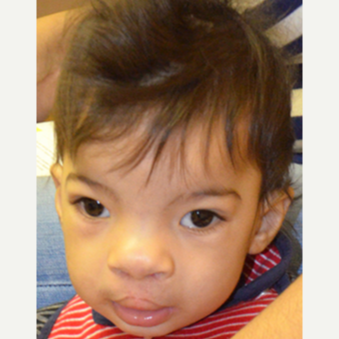 17 or under year old man treated with Cleft Lip And Palate Repair after 3696175