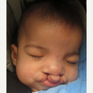 17 or under year old man treated with Cleft Lip And Palate Repair before 3696175