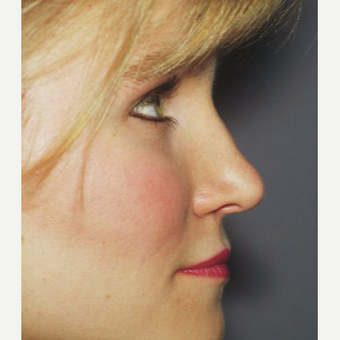 25-34 year old woman treated with Rhinoplasty after 3711494