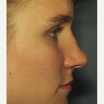 25-34 year old woman treated with Rhinoplasty before 3711494