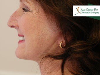 45-54 year old woman treated with Lower Face Lift 1630526