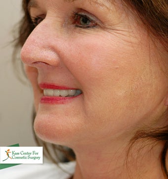 45-54 year old woman treated with Lower Face Lift after 1630526