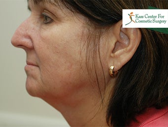 45-54 year old woman treated with Lower Face Lift 1630526