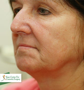 45-54 year old woman treated with Lower Face Lift before 1630526