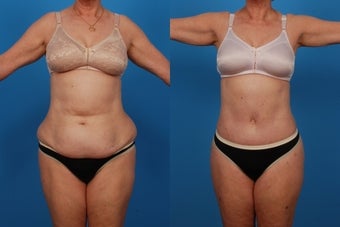 Lipo/Tummy Tuck: 59-Year-Old Woman before 1050719