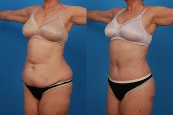 Lipo/Tummy Tuck: 59-Year-Old Woman after 1050719