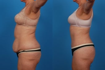 Lipo/Tummy Tuck: 59-Year-Old Woman 1050719