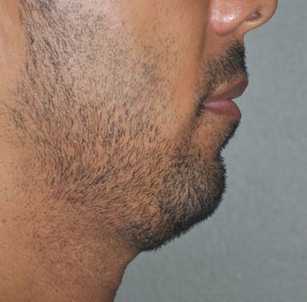 38 Year Old Male Treated For A Small Chin before 923477