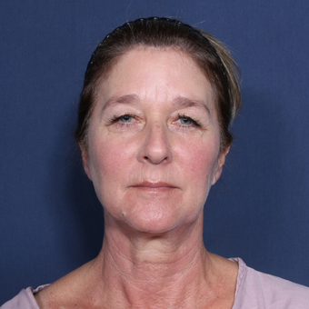 55-64 year old woman treated with Neck Lift (view 1 of 2) before 3174853