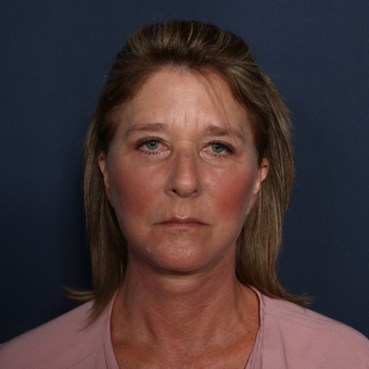 55-64 year old woman treated with Neck Lift (view 1 of 2) after 3174853