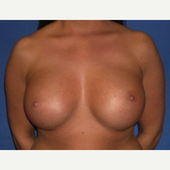 35-44 year old woman treated with Breast Augmentation after 3219970