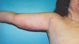 44 year old woman who underwent an arm lift after 672548