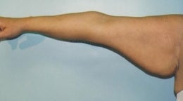 44 year old woman who underwent an arm lift before 672548