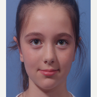 17 or under year old woman treated with Ear Surgery after 3725149