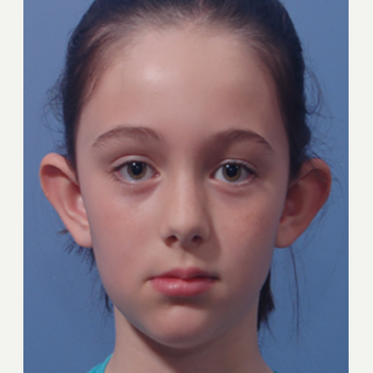 17 or under year old woman treated with Ear Surgery before 3725149