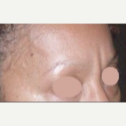 55-64 year old woman treated with Botox before 3163193