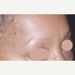 55-64 year old woman treated with Botox after 3163193