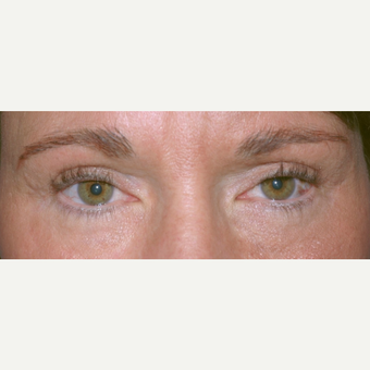 Eyelid Surgery after 3346318