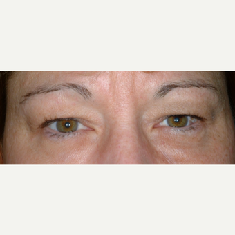 Eyelid Surgery before 3346318
