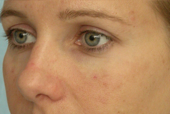 Restylane after 302167