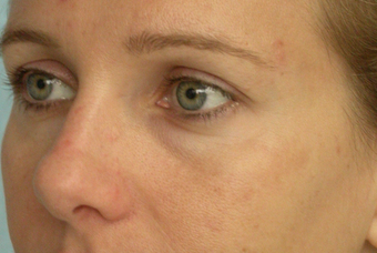 Restylane before 302167
