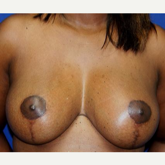 45-54 year old woman treated with Breast Lift after 3037324