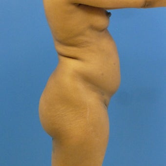38 y.o. female – Liposuction of abdomen, flanks, and back with fat transfer to buttocks – 1200cc pe 1969251