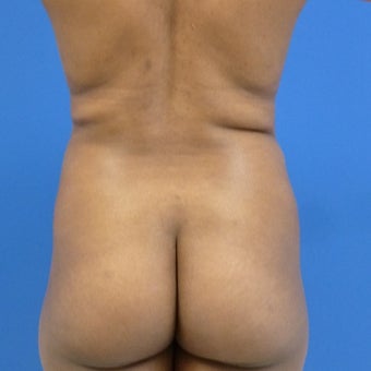 38 y.o. female – Liposuction of abdomen, flanks, and back with fat transfer to buttocks – 1200cc pe before 1969251