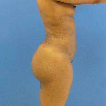 38 y.o. female – Liposuction of abdomen, flanks, and back with fat transfer to buttocks – 1200cc pe 1969251
