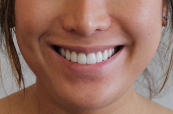 Lip Implant and Dimple Creation before 598462