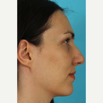 25-34 year old woman treated with Revision Rhinoplasty before 3630133