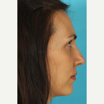 25-34 year old woman treated with Revision Rhinoplasty after 3630133