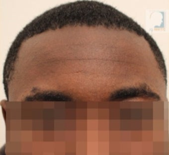 25-30 year-old patient treated with FUE Hair Transplant : Black hair / curly hair results after 3120353