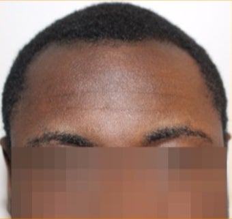 25-30 year-old patient treated with FUE Hair Transplant : Black hair / curly hair results before 3120353