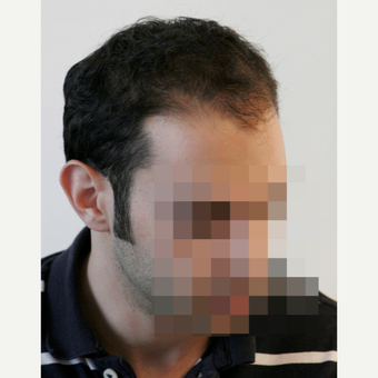 25-34 year old man treated with FUE Hair Transplant before 3068872