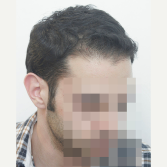 25-34 year old man treated with FUE Hair Transplant after 3068872