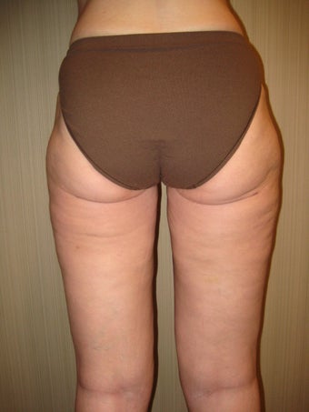50 year old female before and after SmartLipo of her thighs after 626264