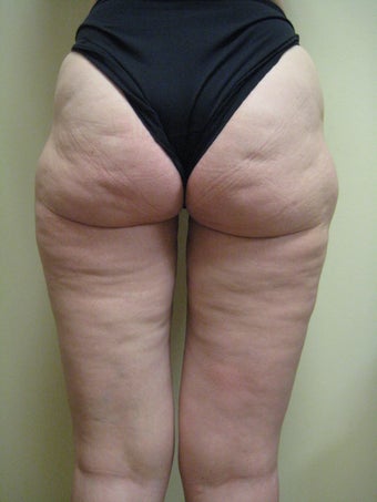 50 year old female before and after SmartLipo of her thighs before 626264