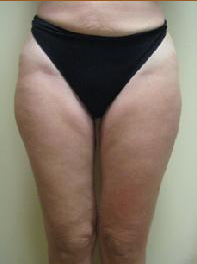 50 year old female before and after SmartLipo of her thighs 626264