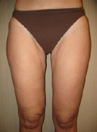 50 year old female before and after SmartLipo of her thighs 626264
