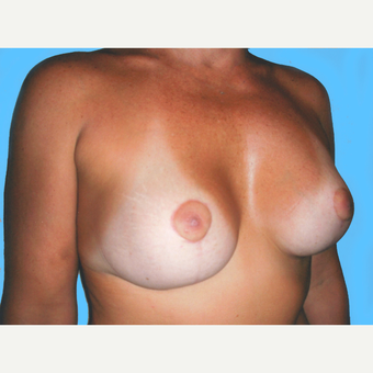 Breast Lift with Implants after 3748616