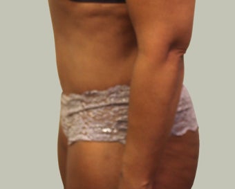 Abdominoplasty 1722745