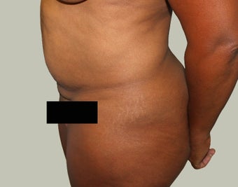 Abdominoplasty 1722745