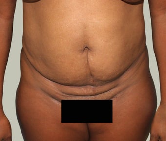 Abdominoplasty before 1722745