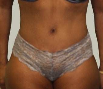 Abdominoplasty after 1722745