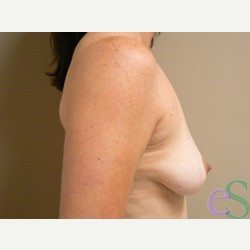 Breast Lift with Implants before 3373442