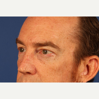 Eyelid Surgery after 3744023