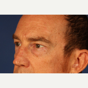 Eyelid Surgery before 3744023